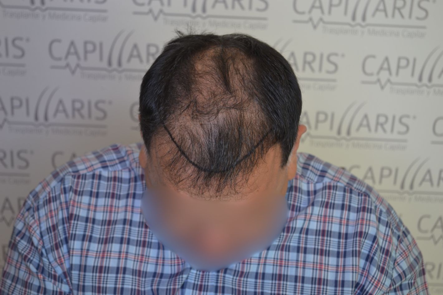 Antes