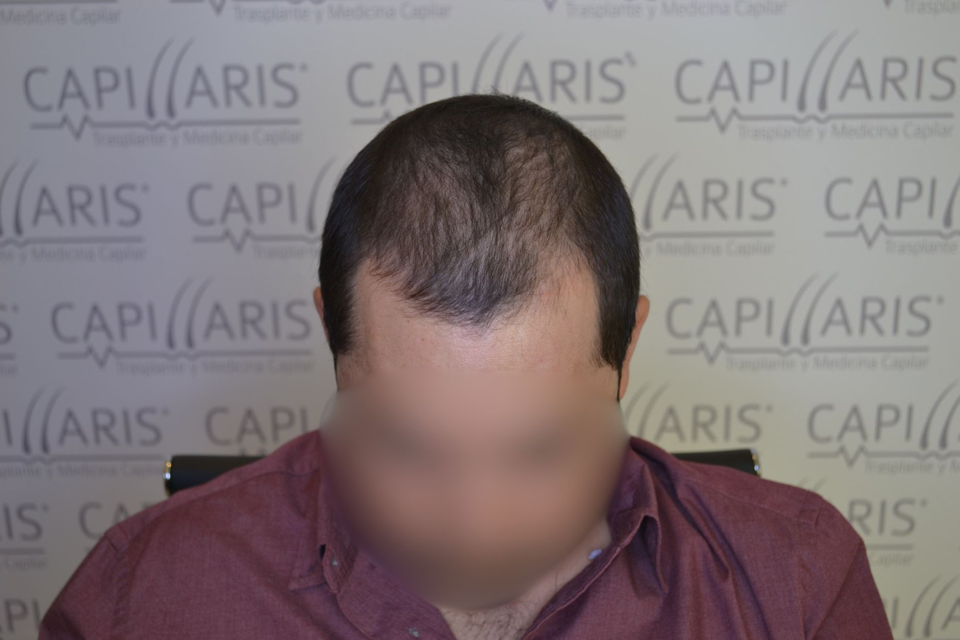 Antes
